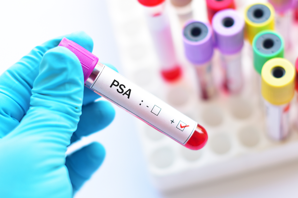 What you Should Know about PSA Testing | Farhad Nowzari, MD